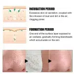 New Blackhead Removal Nose Mask Pore Patch Blackhead Mask Exfoliating Blackhead Deep Cleansing Skin Care Beauty Health - Image 10